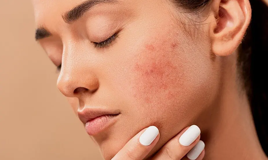 How to Prevent Acne?