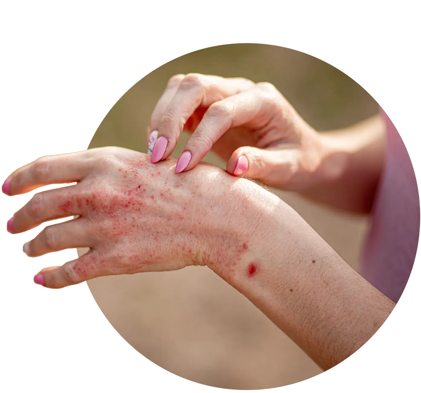 Get Advanced Homeopathy Treatment for Allergy