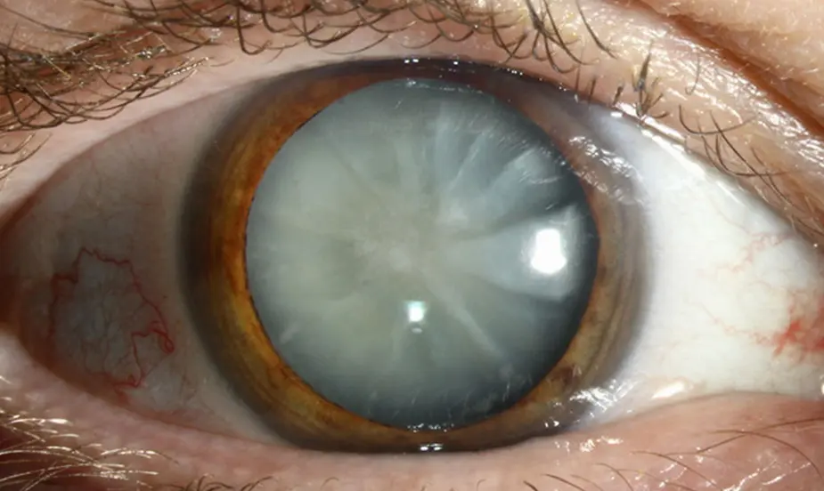 Common Triggers of Cataracts