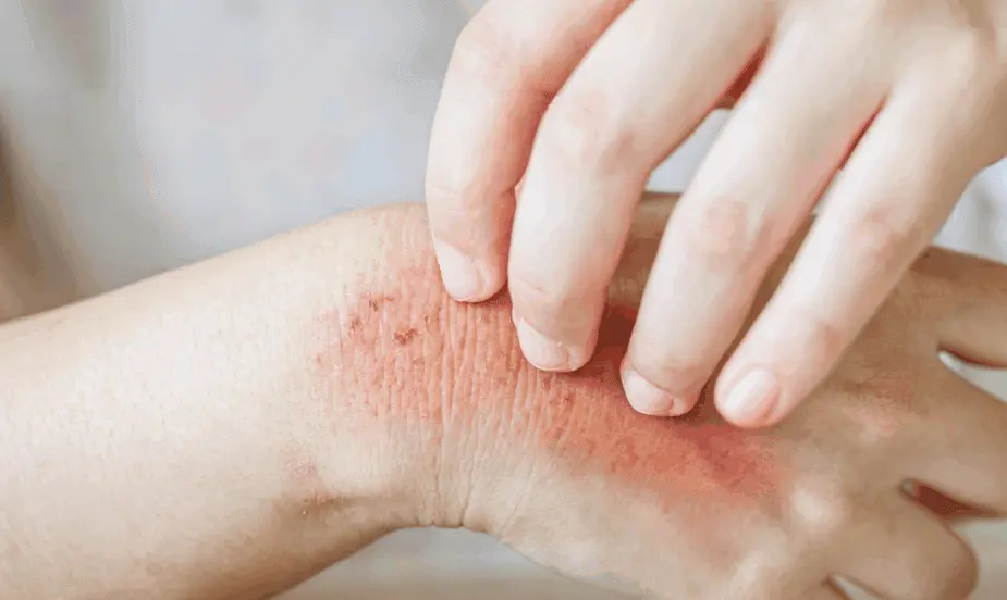 How to Prevent Allergy?