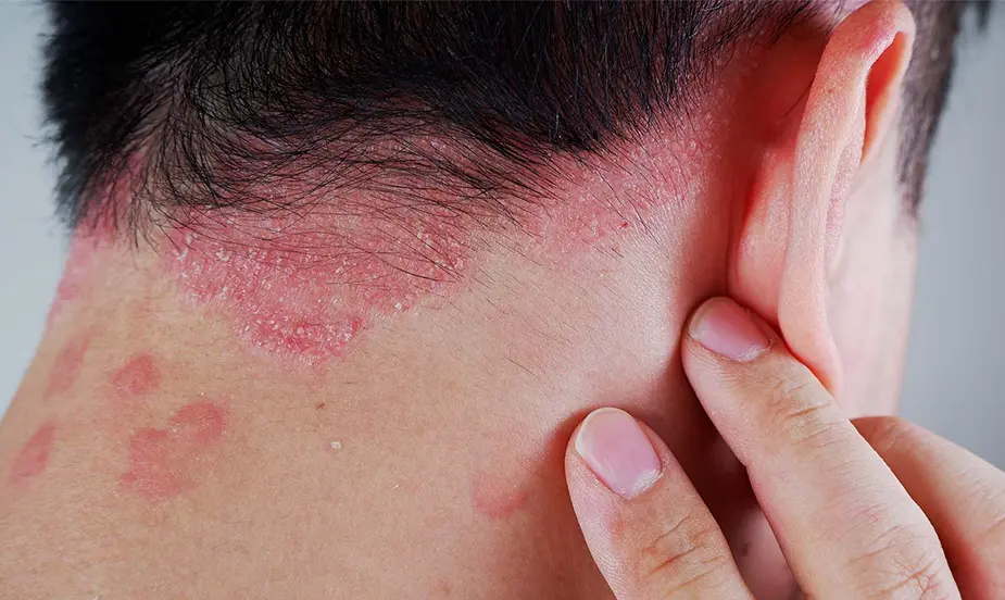How to Prevent Psoriasis?