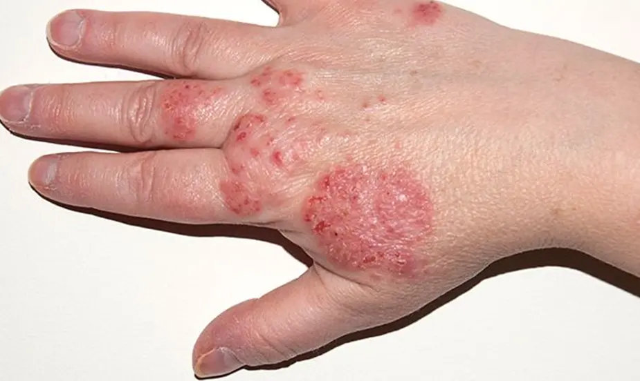 How to Prevent Eczema?