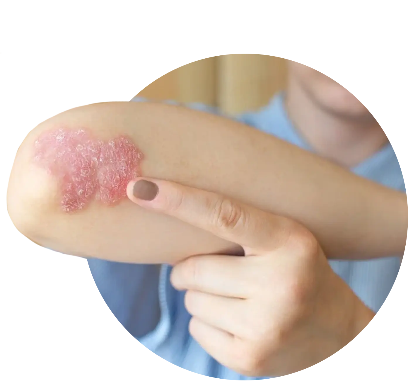Advanced Homeopathy Treatment for Psoriasis
