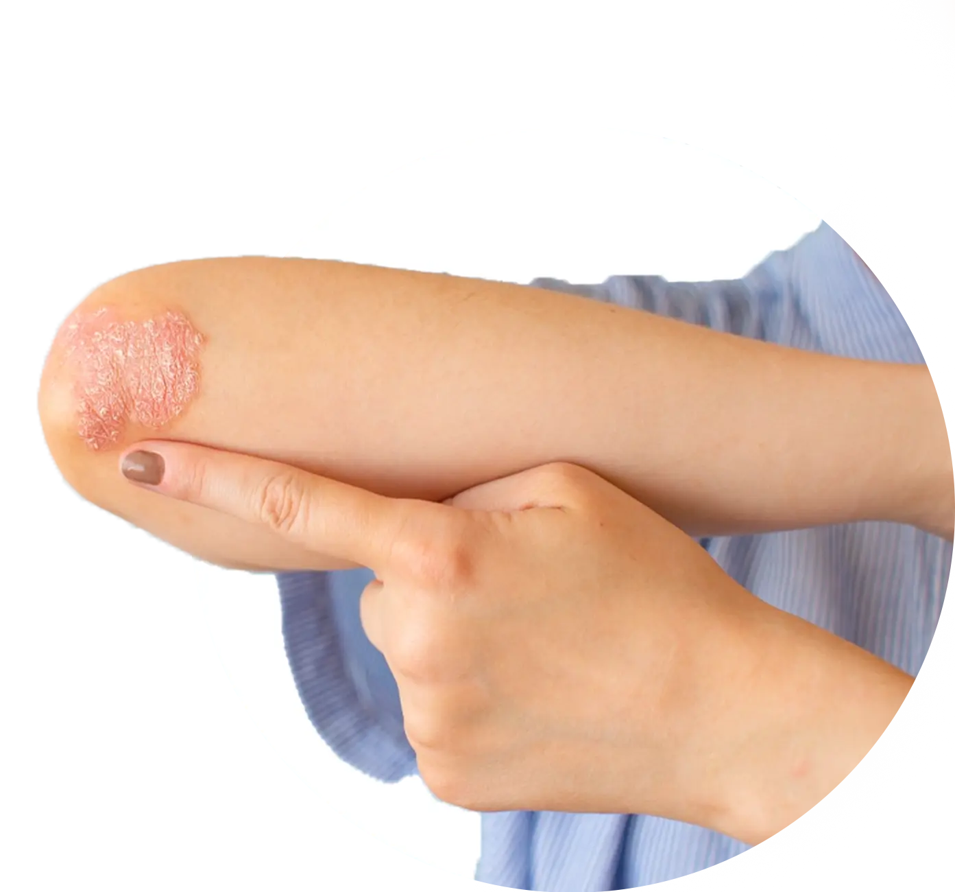 Advanced Homeopathy Treatment for Ringworm