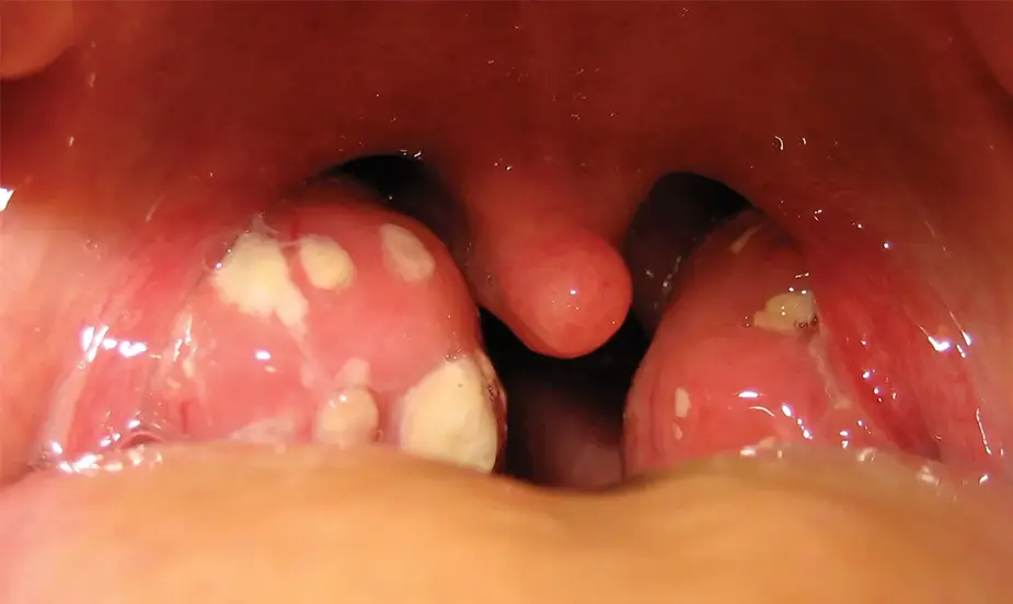 Common Triggers of Tonsil Infection