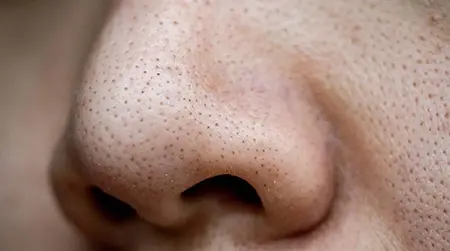 Blackheads