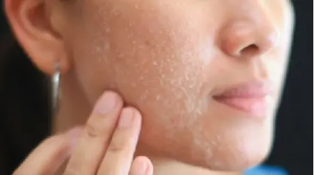Dry Skin