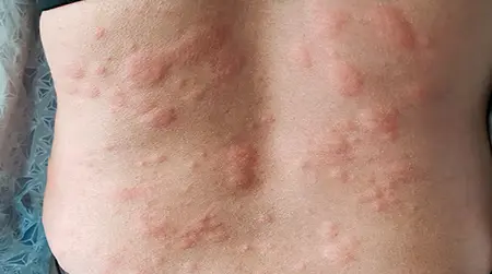 Skin rashes