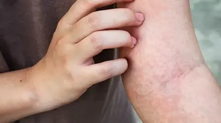 Skin itching