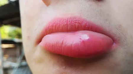 Swollen Lips