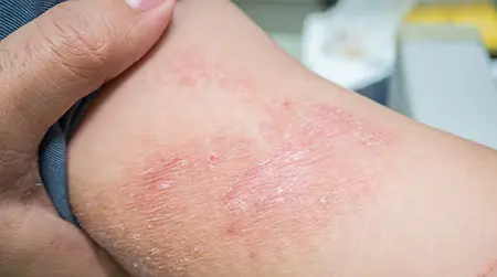 Allergic  Dermatitis