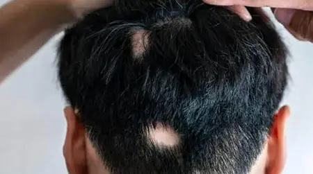 Alopecia Areata