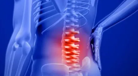 Ankylosing Spondylitis
