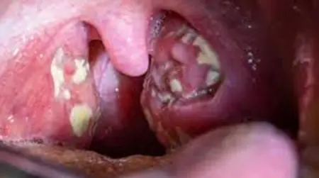 Bacterial Tonsillitis