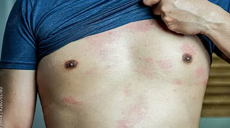 Body Psoriasis