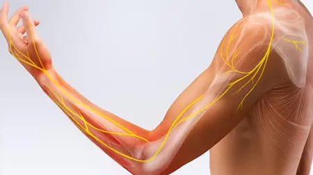 Cervical Radiculopathy