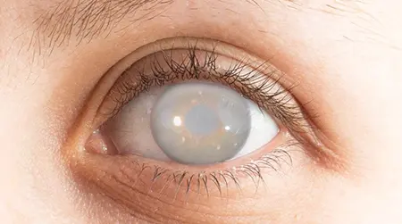 Congenital Cataract