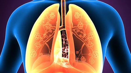Eosinophilic  Asthma