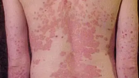 Erythrodermic  Psoriasis