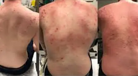 Exercise-Induced Allergy