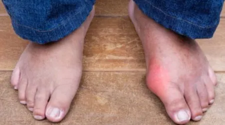 Gout Arthritis