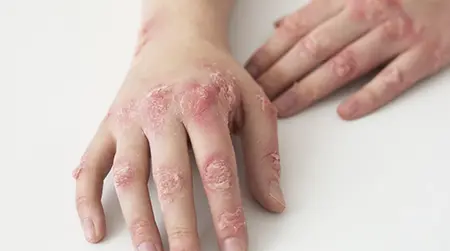 Hand Ringworm