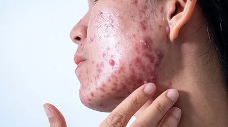 Hormonal Acne