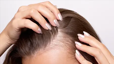 Hormonal Hair Loss