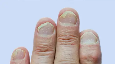 Nail  Psoriasis