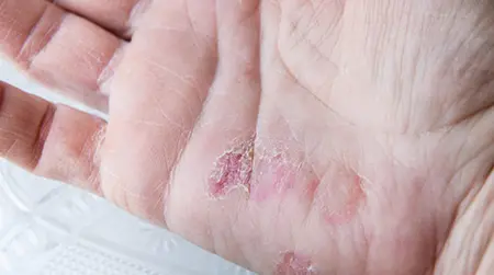 Palmoplantar  Psoriasis