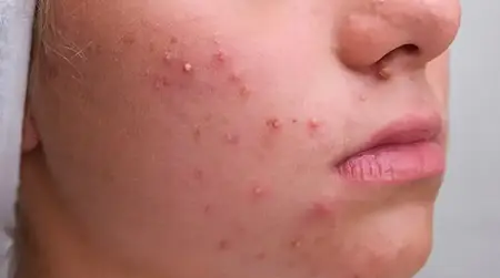 Pustular Acne