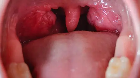 Recurrent Tonsillitis