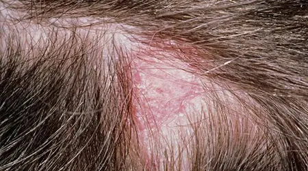 Scalp Ringworm