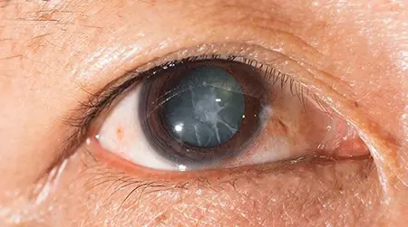 Traumatic Cataract
