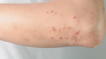 Urticaria  Hives