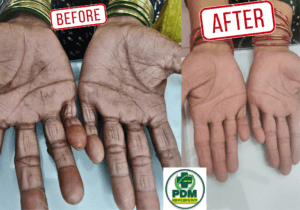 Psoriasis Treatment at PDM Homeopathy Hospital