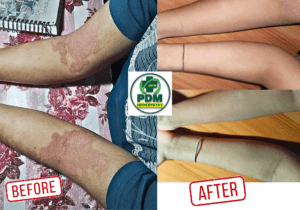 Eczema Relief Solutions | Expert Tips & Treatments