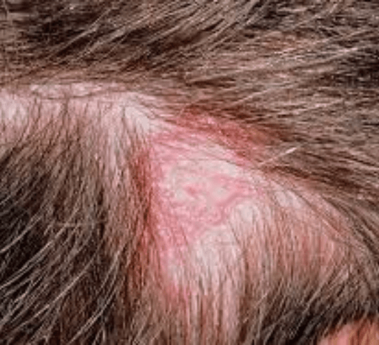 Tinea Capitis Ringworm Treatment at PDM Homeopathy Hospital