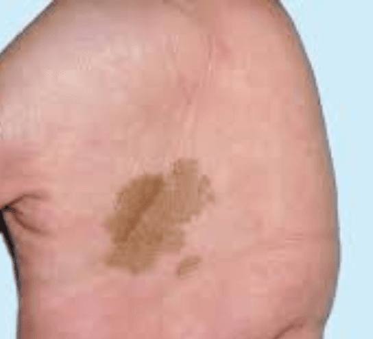 Tinea Nigra Ringworm Treatment at PDM Homeopathy Hospital