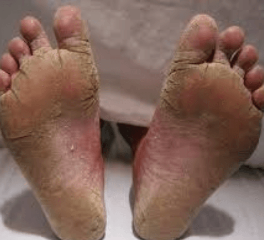 Tinea Pedis Ringworm Treatment at PDM Homeopathy Hospital