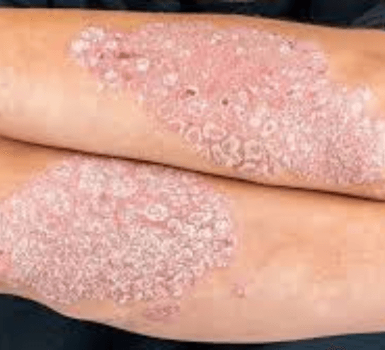 Psoriasis Treatment at PDM Homeopathy Hospital