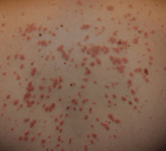 Psoriasis Treatment at PDM Homeopathy Hospital