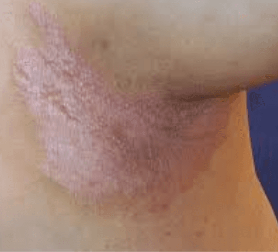 Tinea Cruris Ringworm Treatment at PDM Homeopathy Hospital