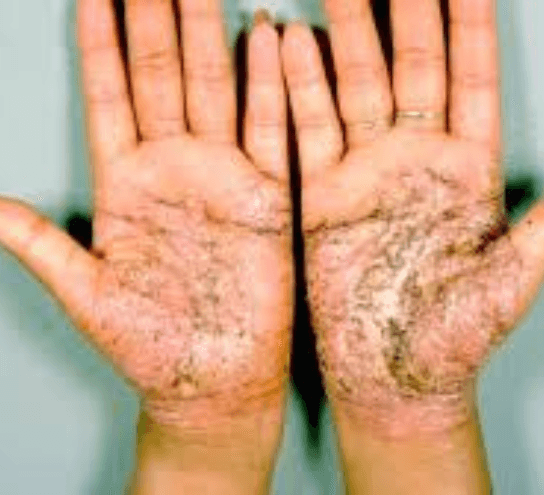 Psoriasis Treatment at PDM Homeopathy Hospital