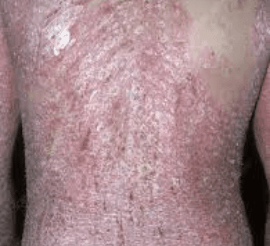 Psoriasis Treatment at PDM Homeopathy Hospital