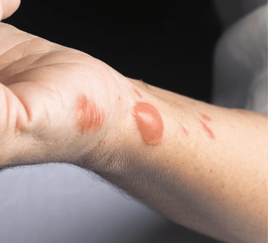 Skin Allergy Treatment at PDM Homeopathy Hospital