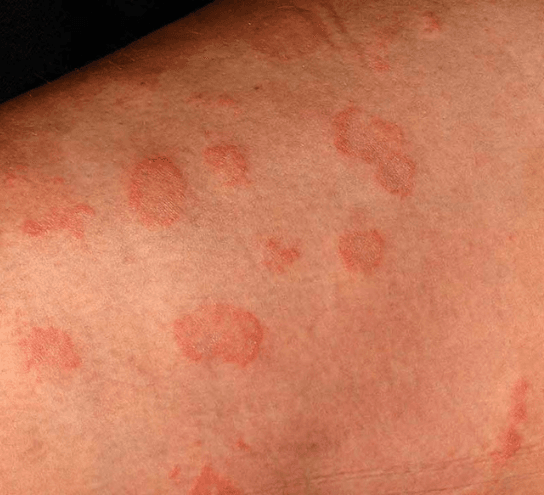 Eczema Relief Solutions | Expert Tips & Treatments