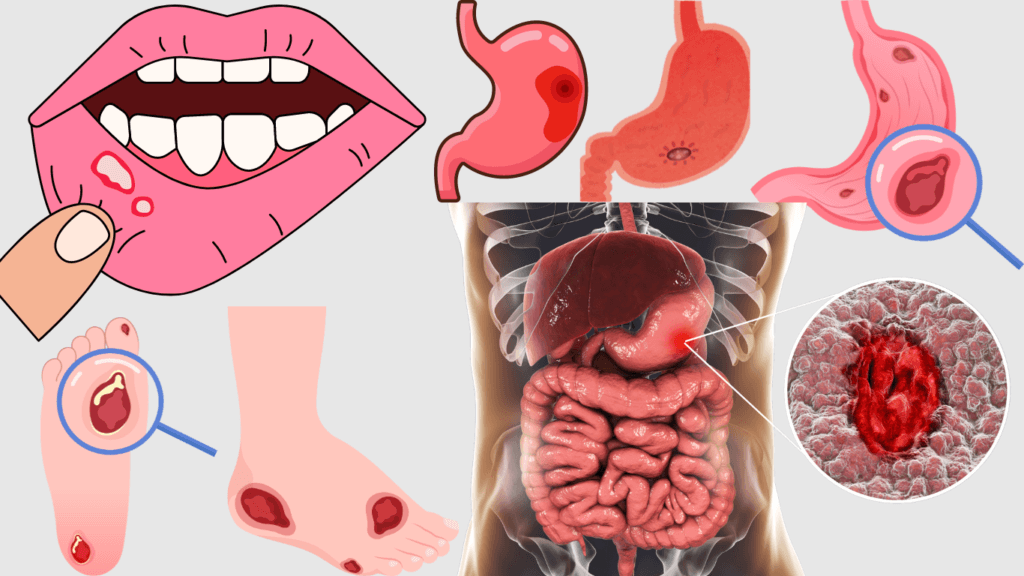 Ulcers Facts: Causes, Symptoms, Risk Factors