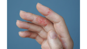 Eczema Symptoms: Causes and Effective Treatments