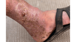 Ulcers: Causes, Symptoms, and Effective Homeopathic Treatment